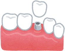 インプラントの埋入手術（1次手術）