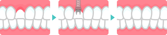 歯を1本失った場合